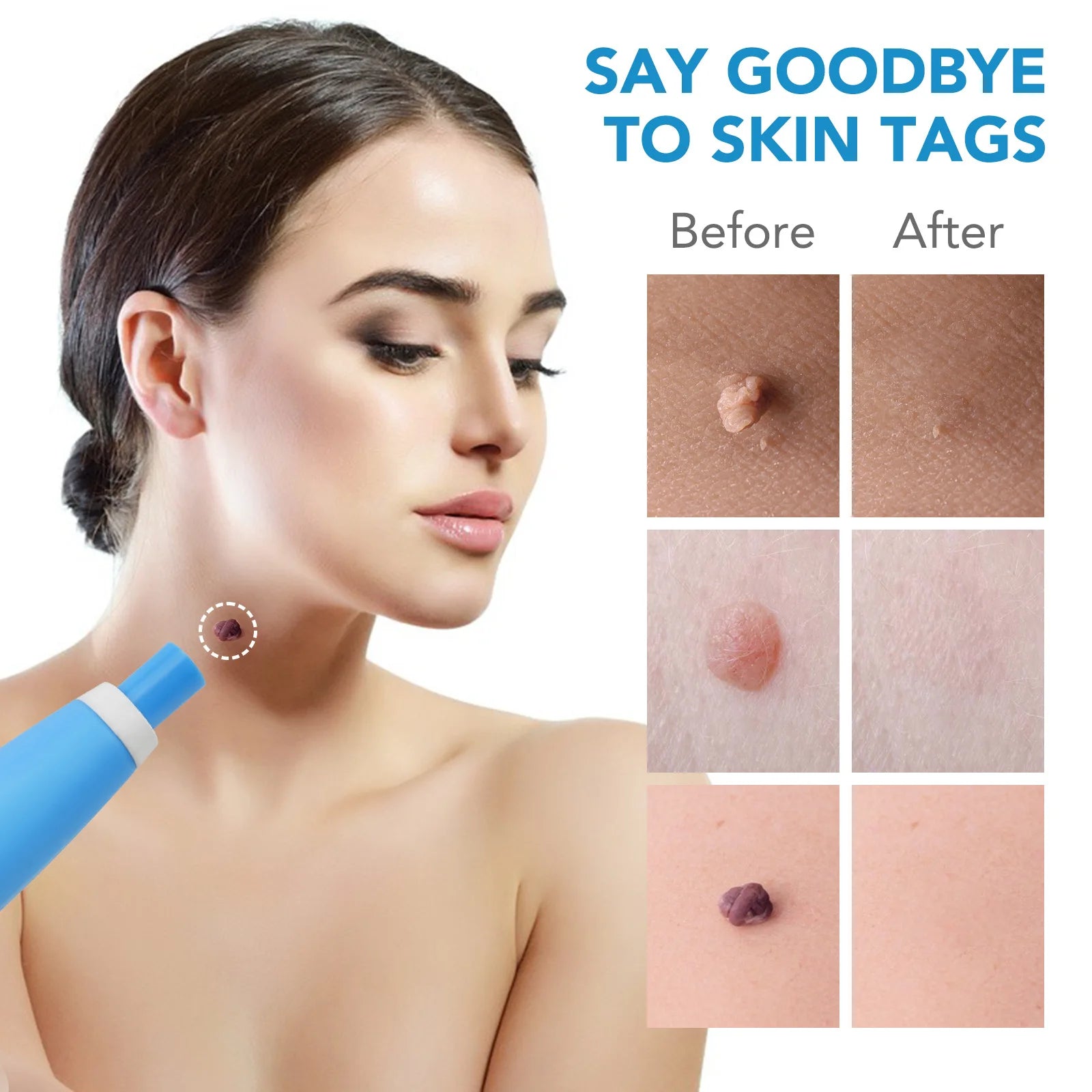 Painless Skin Tag Remover Kit