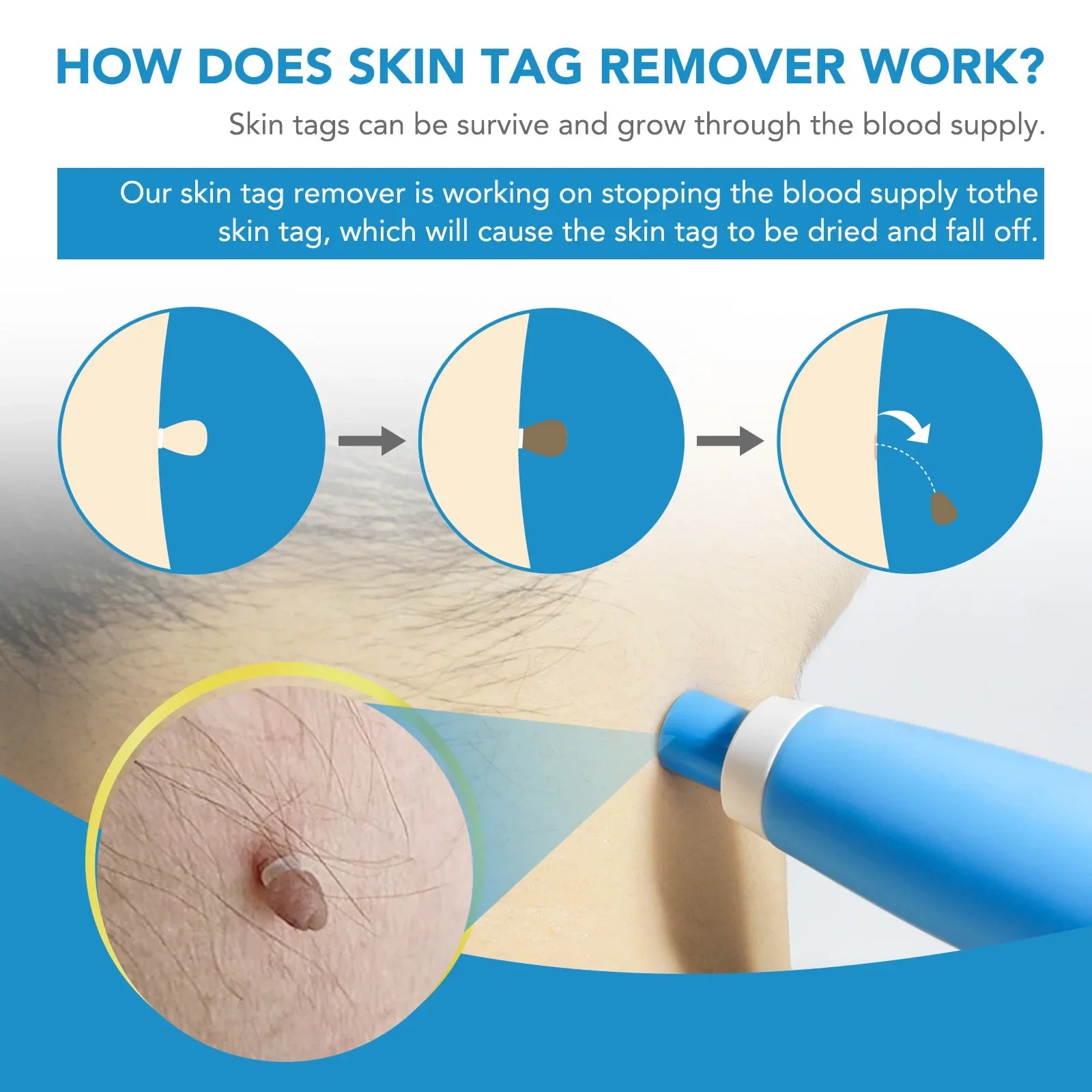 Painless Skin Tag Remover Kit